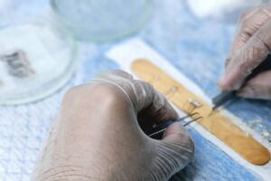 Hair Transplant in Turkey